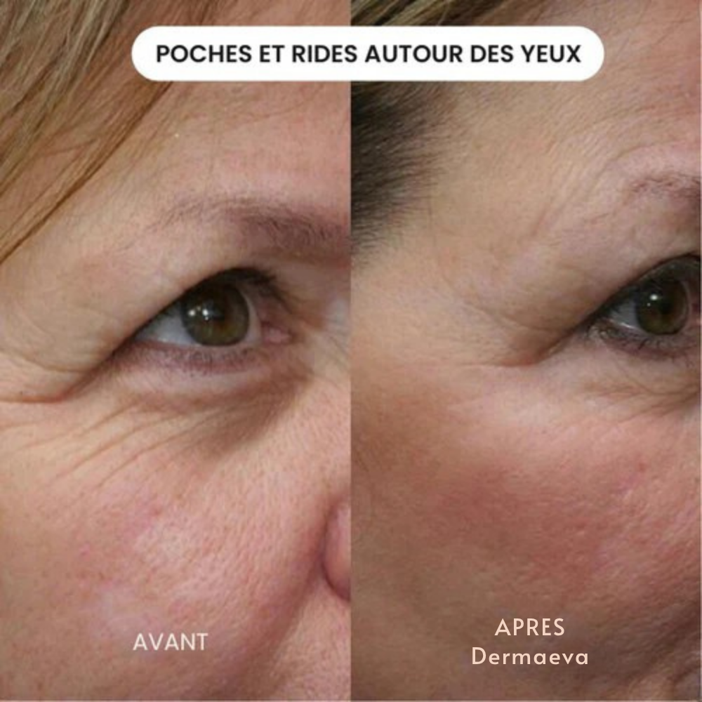 Le Système d’Infusion par Dermaeva™