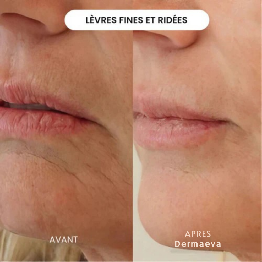 Le Système d’Infusion par Dermaeva™
